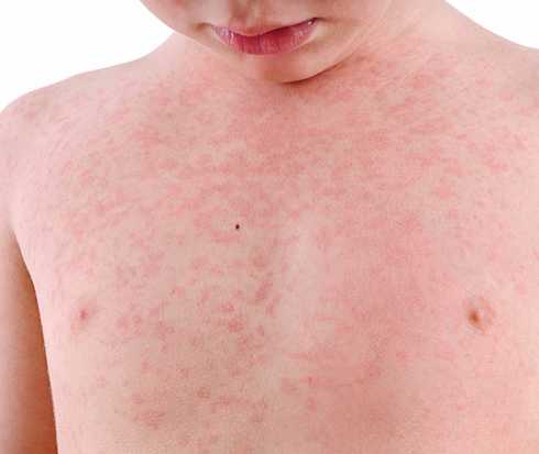 Die nackte Brust eines Kindes mit Ausschlag