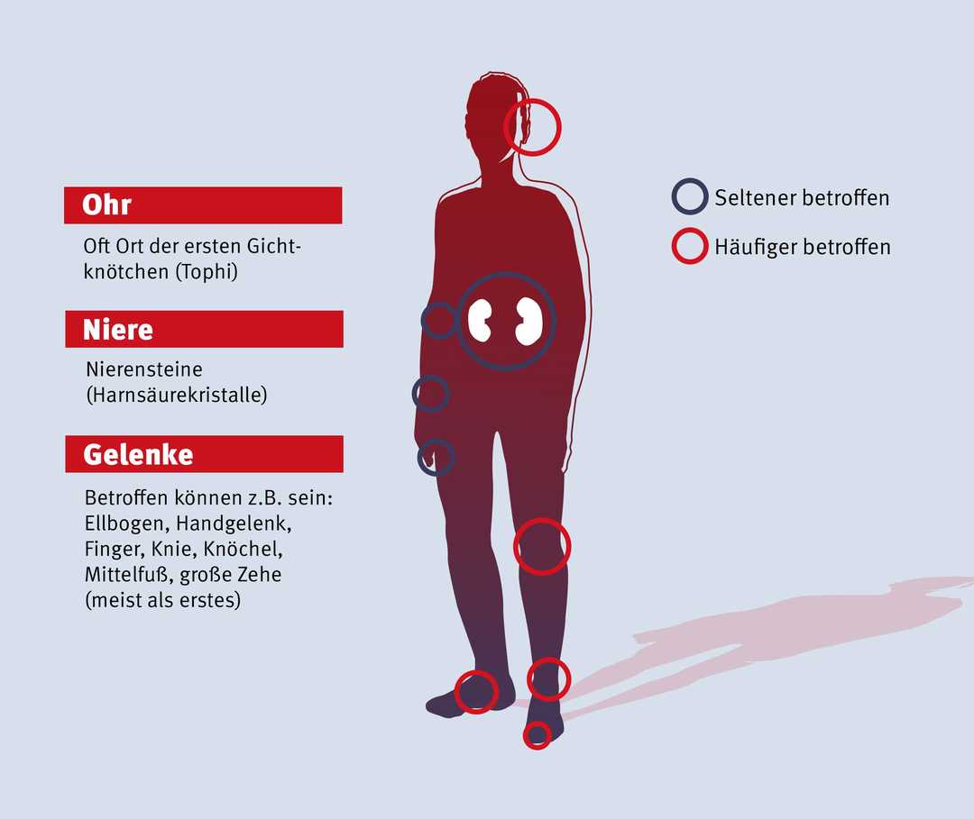 Von Gicht betroffene Bereiche des Körpers