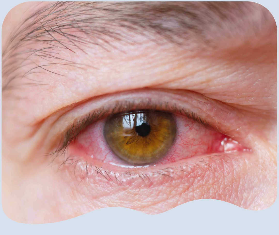 Mann mit geröteten Augen