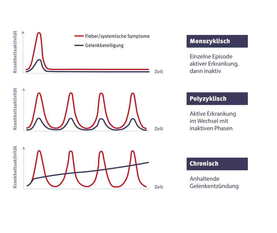 Verlauf und Komplikationen bei adultem Morbus Still (AOSD)