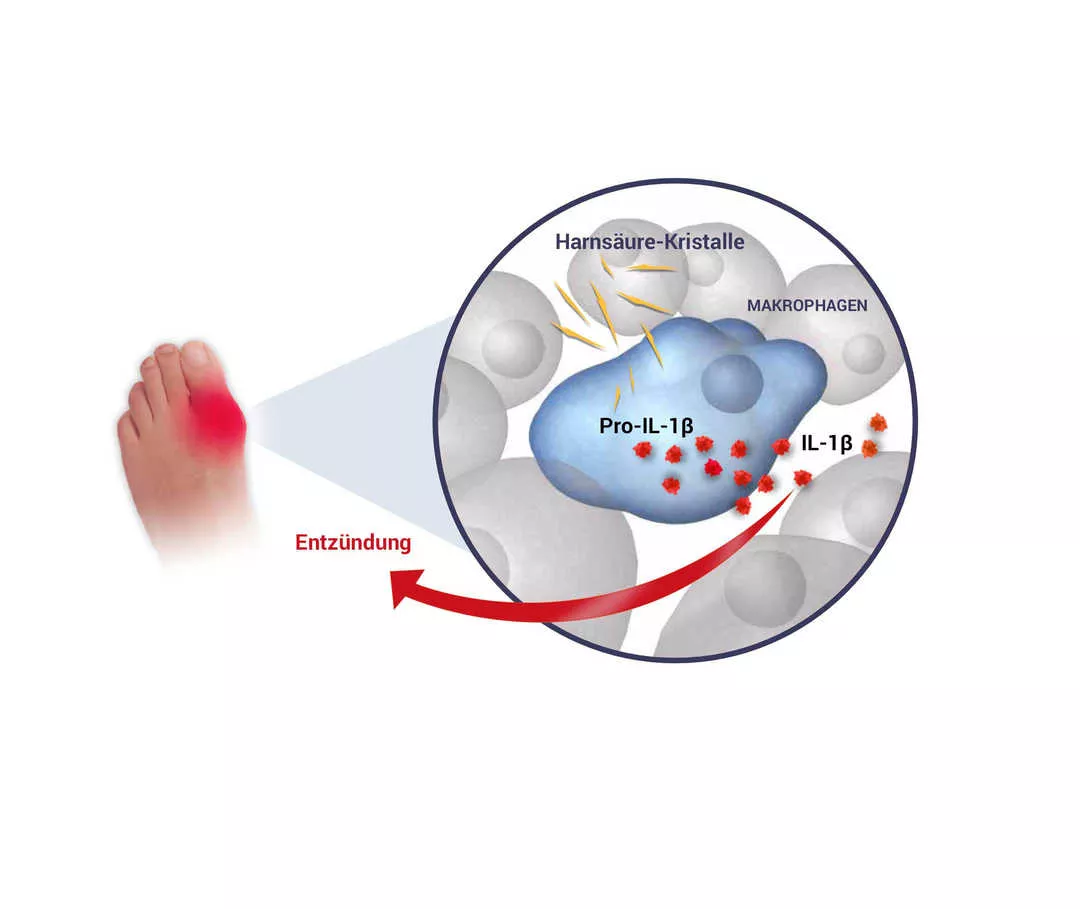 Harnsäure-Kristalle fördern die Freisetzung von IL-1 in Gelenken