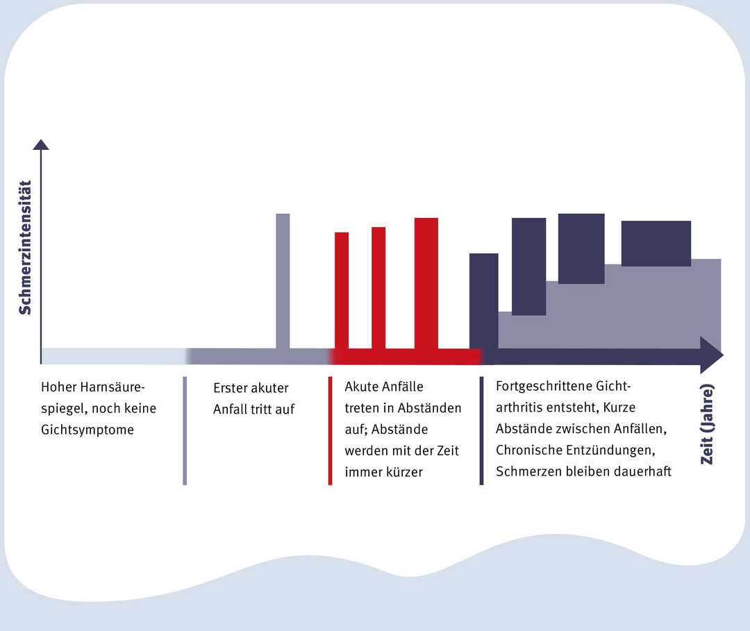 Verlauf einer Gicht Erkrankung