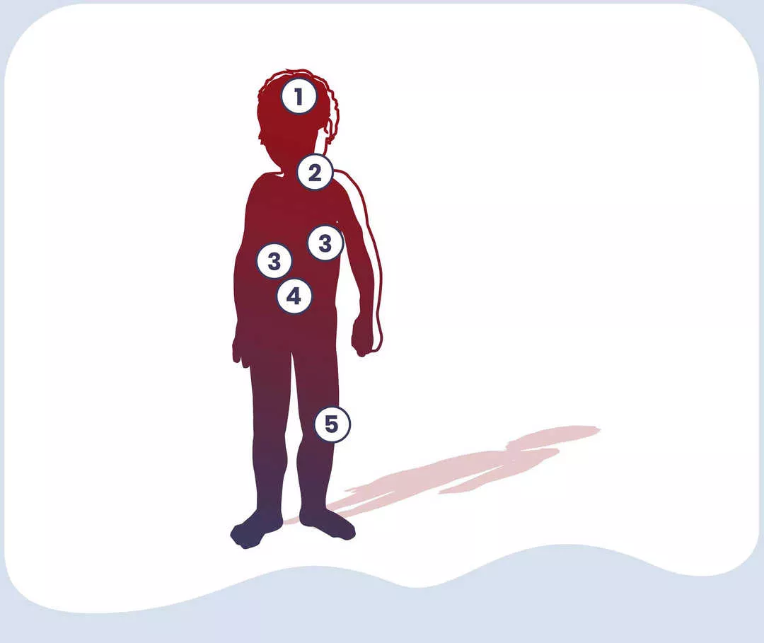 Beschwerden bei HIDS nummerierte Grafik