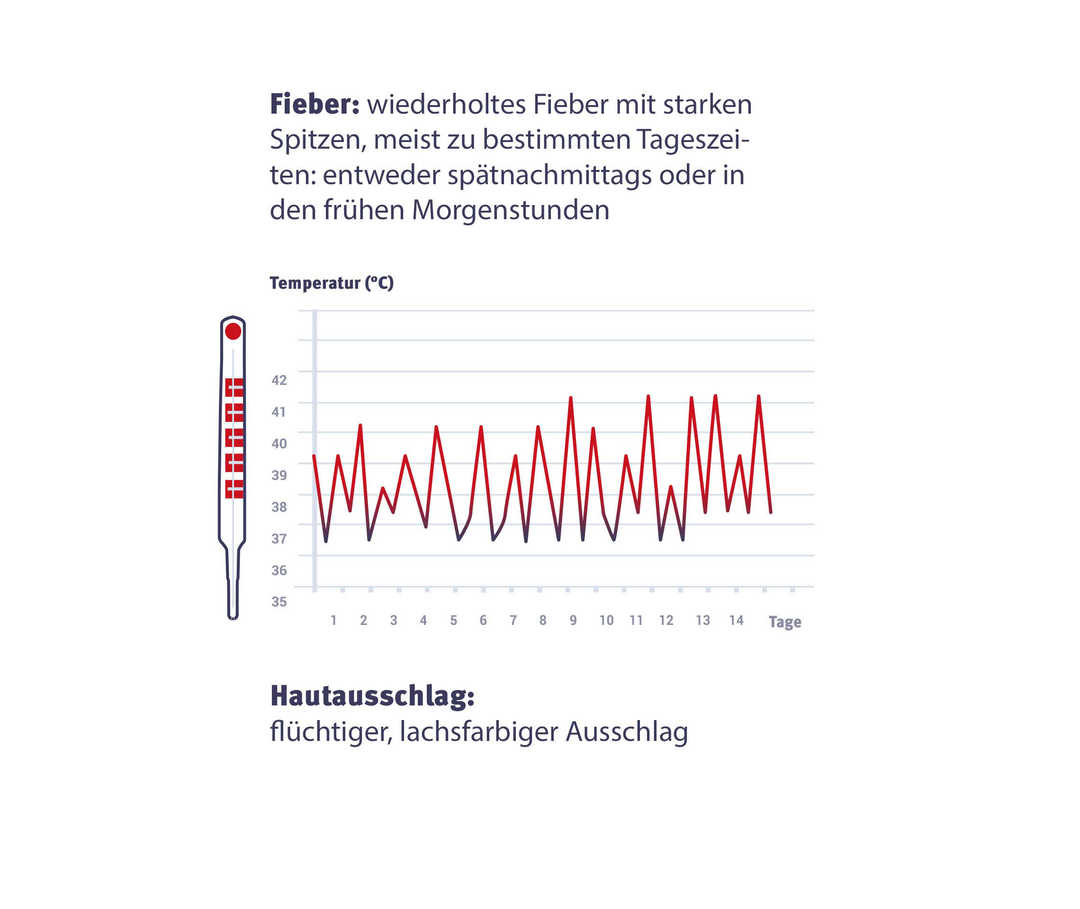 Mögliche Symptome bei juvenilem Morbus Still (SJIA) Fieber-Verlauf