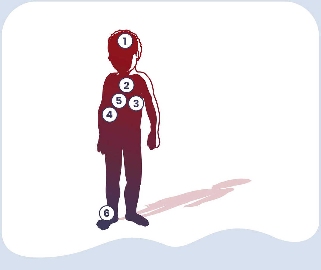 Mögliche Symptome bei juvenilem Morbus Still (SJIA) nummerierte Grafik